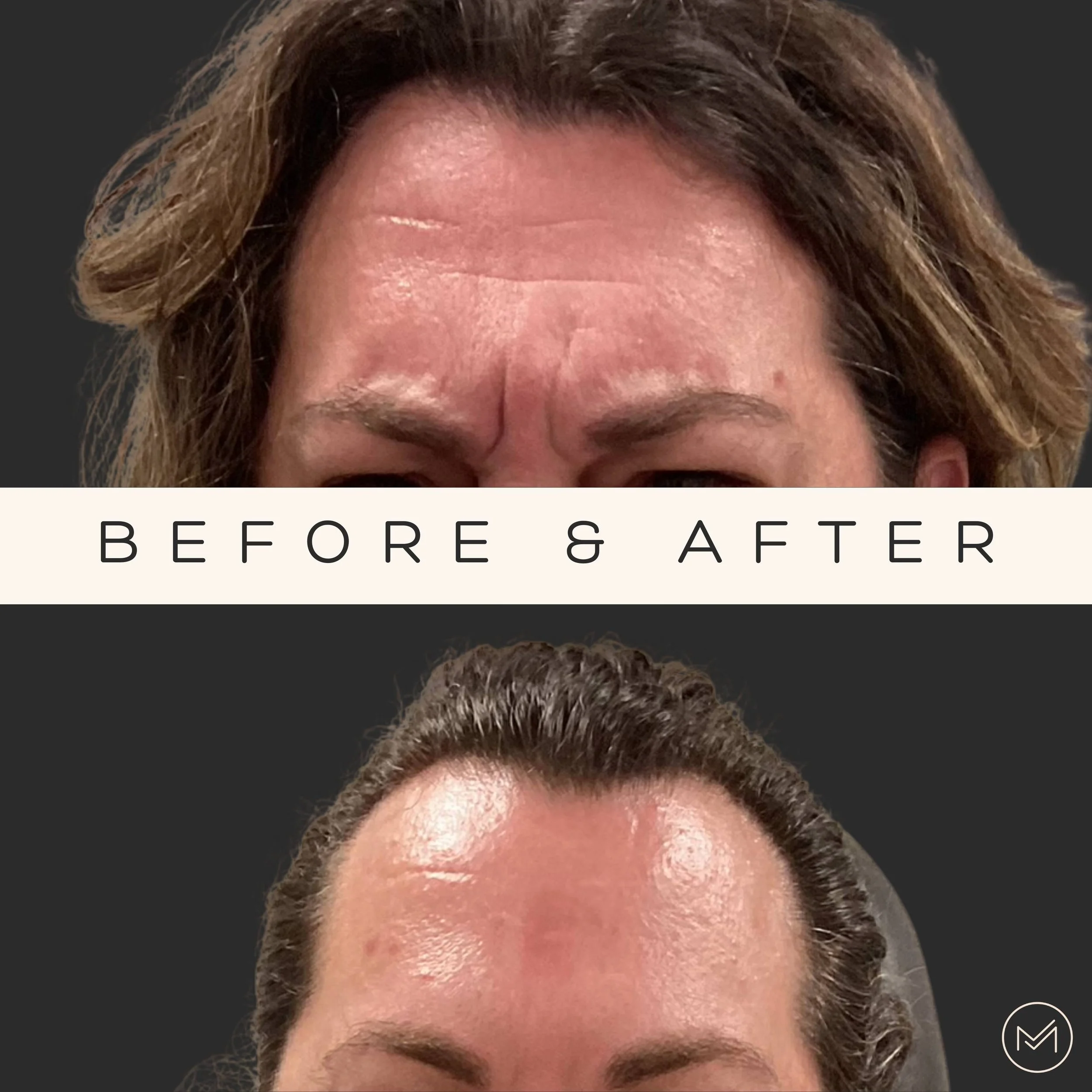 See Our Stunning Before and After Results Morph Med Spa CT — Morph Med